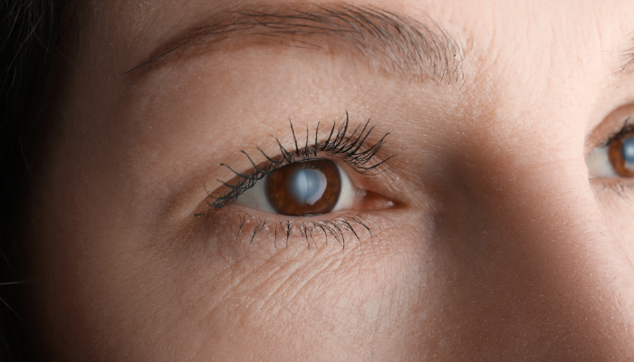 Lower Blepharoplasty for Under-Eye Bags: